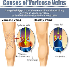 Hyggear Varicose Veins Patch - Natural Relief Treatment for Legs, Spider Varicose Vein and Strengthen Capillary Health
