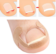 Hyggear Ingrown Toenail Set with Breathable Ingrown Toenail Strips