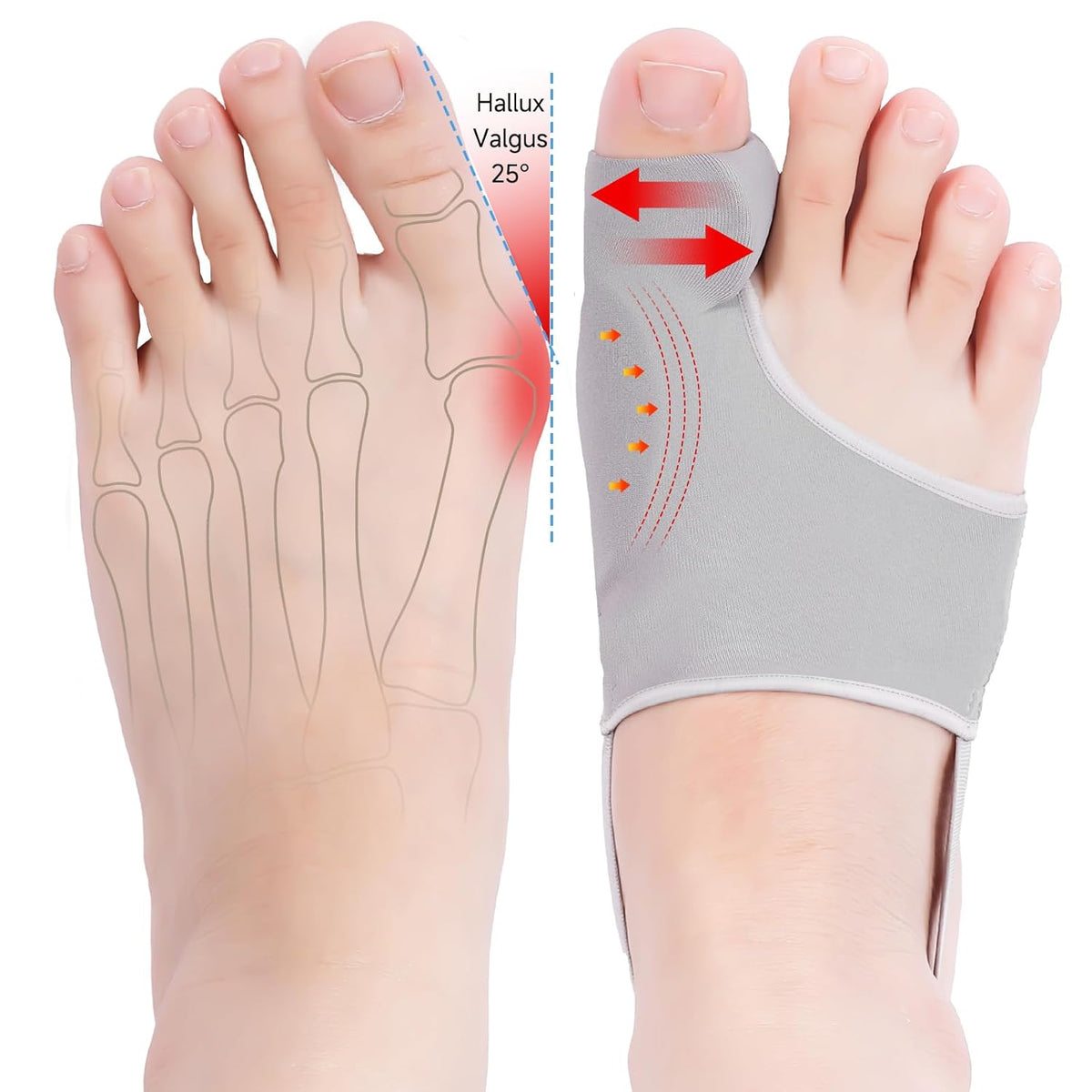Hyggear Big Toe Bunion [Hallux Valgus] Corrector For Everyone