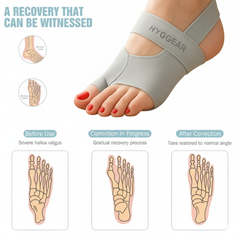 Hyggear Corrector [Big Toe Bunion , Hallux Valgus]