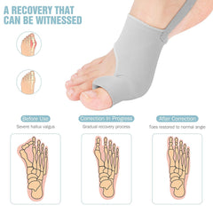 Hyggear Big Toe Bunion [Hallux Valgus] Corrector For Everyone